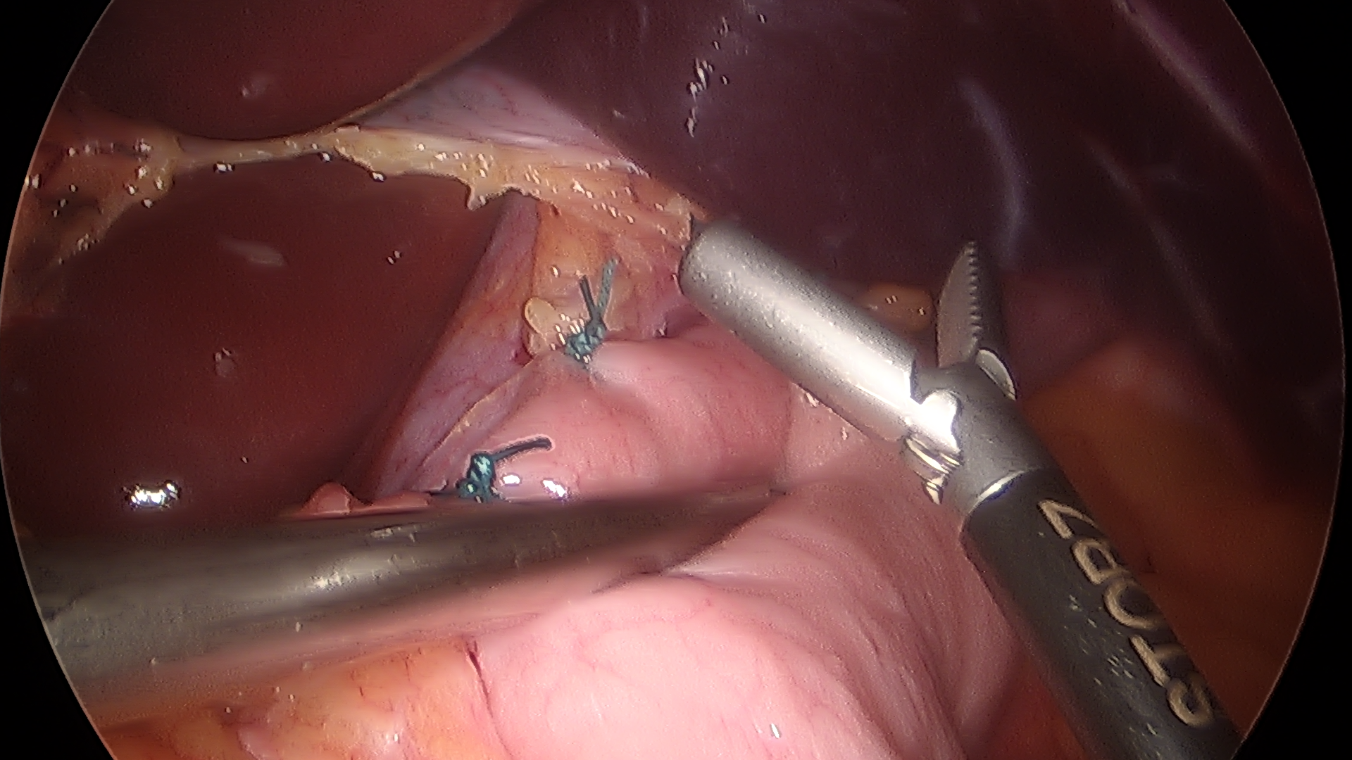 Weight loss surgery moncton nb image 6